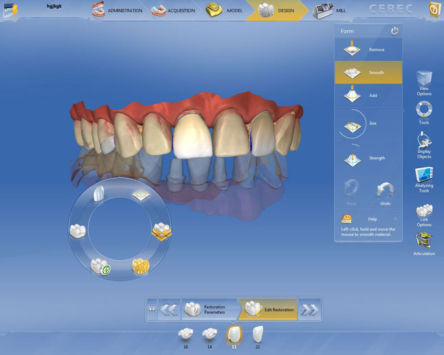 CEREC 디지털 구강 스캔