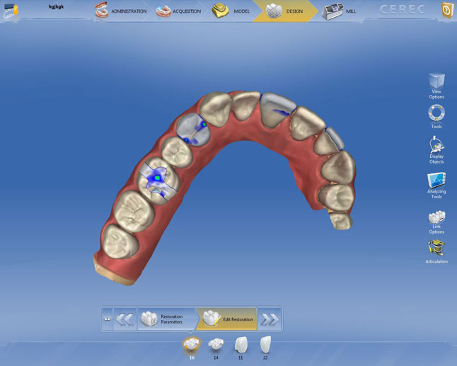 CEREC 보철물 디자인