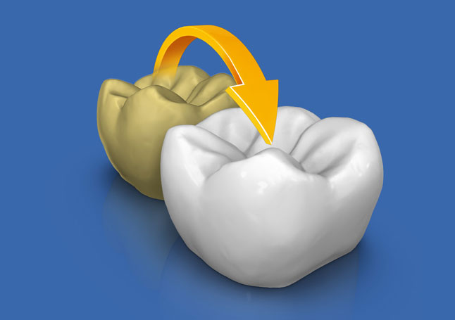 CEREC 원내 보철물 제작