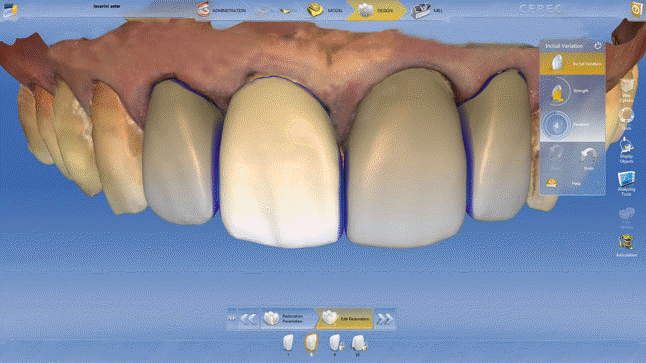 CEREC 환자 중심 진료